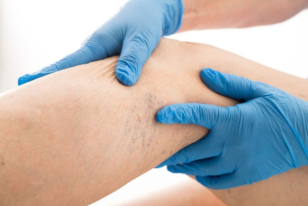 Klinik Kartin Varisoz Hastalığı