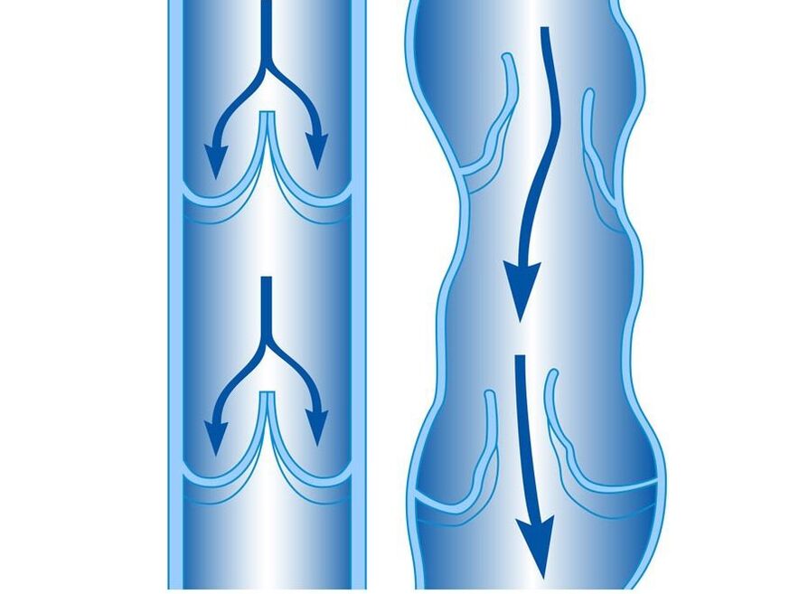 sağlıklı ve varisli damar